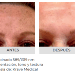AdvaTx en Morelia | Tratamiento Láser para Rosácea y Acné