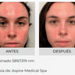 AdvaTx en Morelia | Tratamiento Láser para Rosácea y Acné