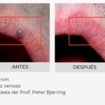 AdvaTx en Morelia | Tratamiento Láser para Rosácea y Acné